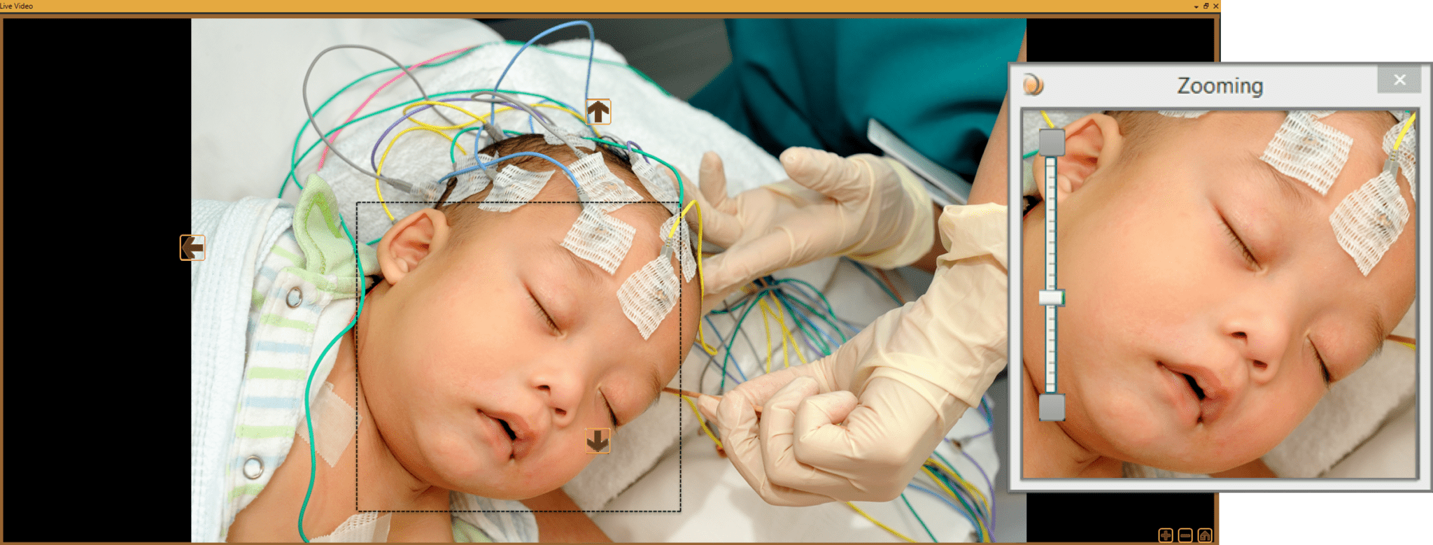 NICU EEG for Neonate Brain Health Monitoring Cadwell EEG
