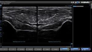 Sierra NMUS+ Dual Image Muscle Compare
